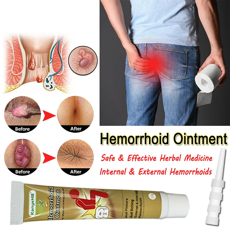 Melem za hemoroide Učinkovit tretman domaćih pilota, vanjski analni pukotina, akne, analni bol, kineska medicinska pomoć1